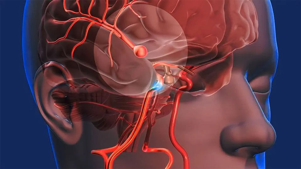 accidente cerebrovascular