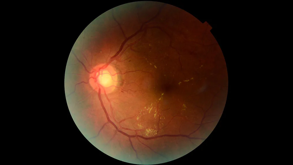 RETINAR-3