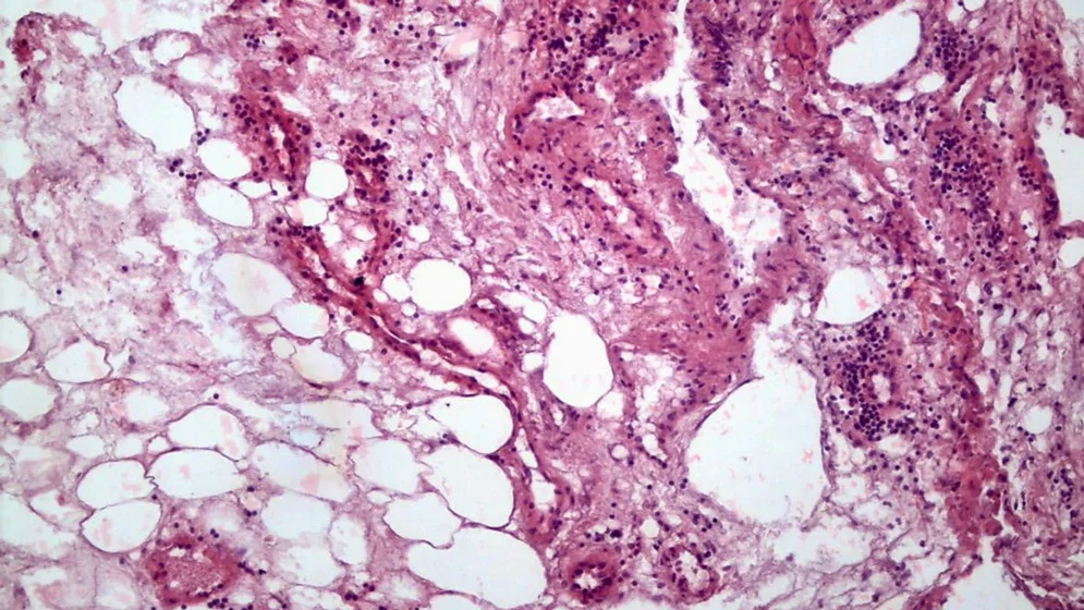 tumor-renal_WEB